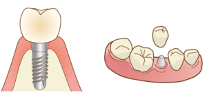 インプラント