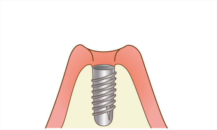 インプラント体(人工歯根)