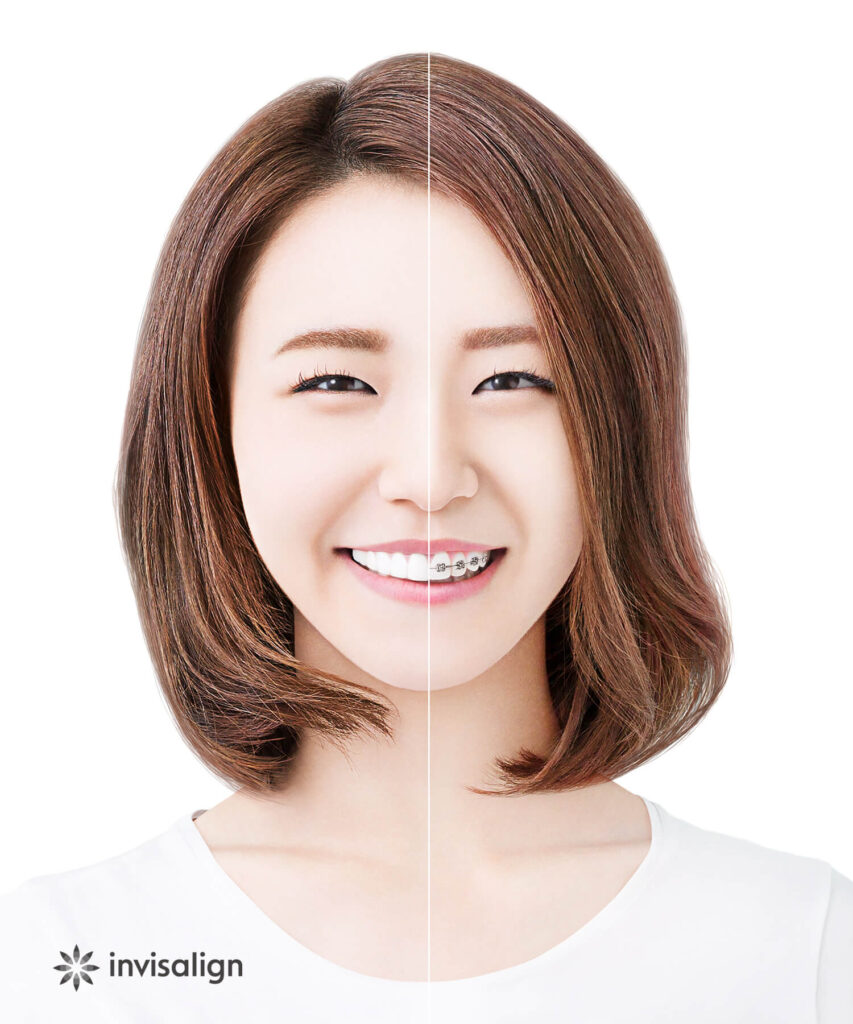 ワイヤー矯正とマウスピース矯正の比較