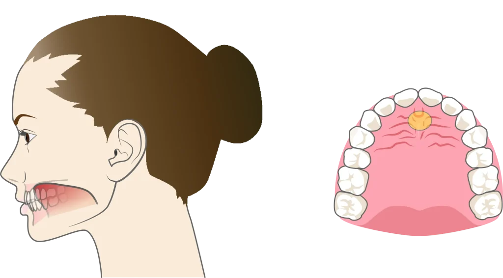 正しい舌の位置「スポット」