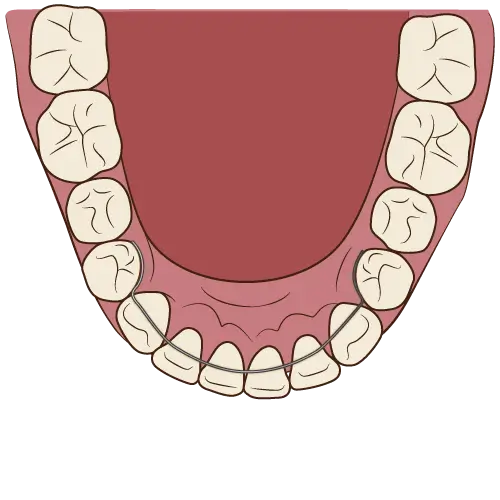 ボンデッドリテーナー（固定式保定装置）