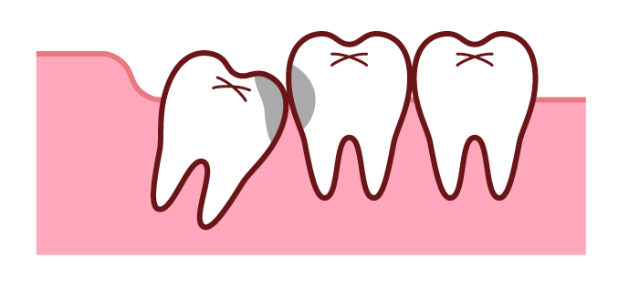 虫歯になっている親知らずとその隣の歯