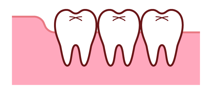 正常に生えそろった親知らず