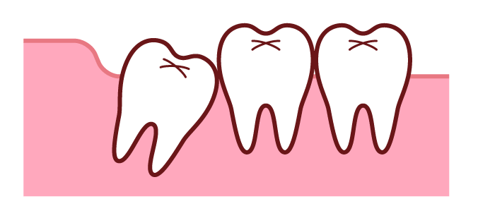 斜めに生えている親知らず