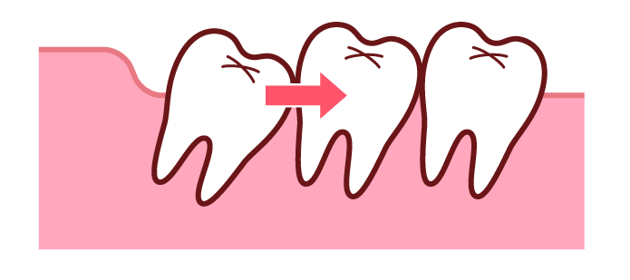 他の歯を押している親知らず