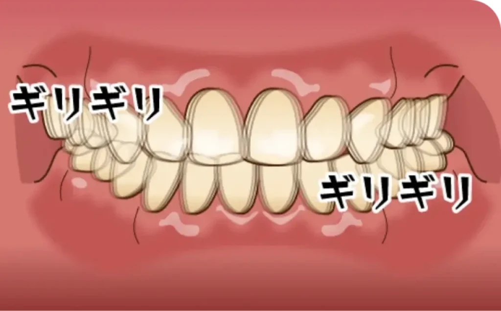 歯ぎしり・食いしばり