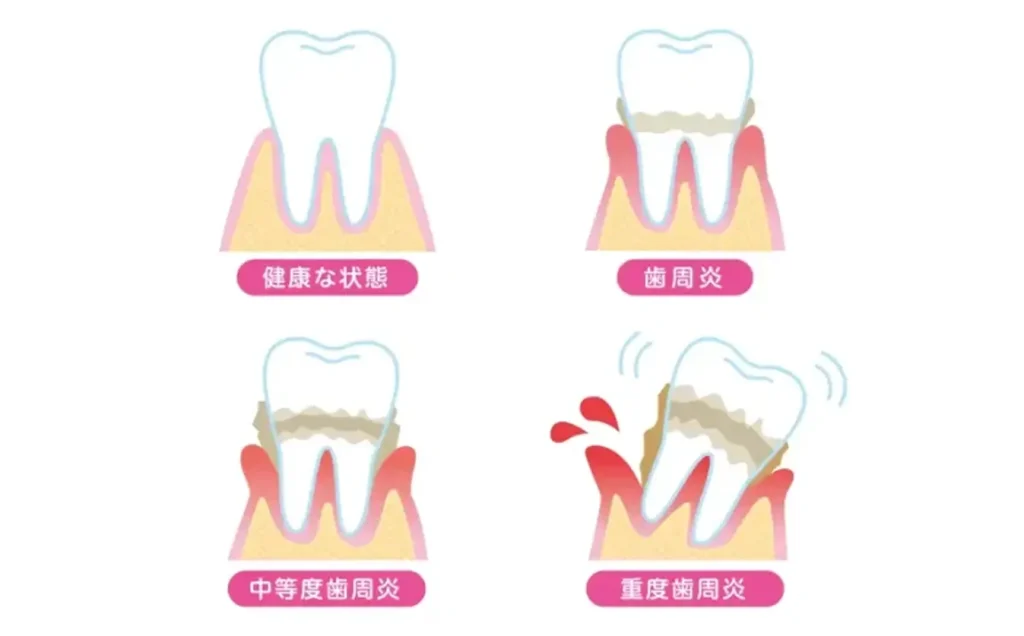 歯周外科手術