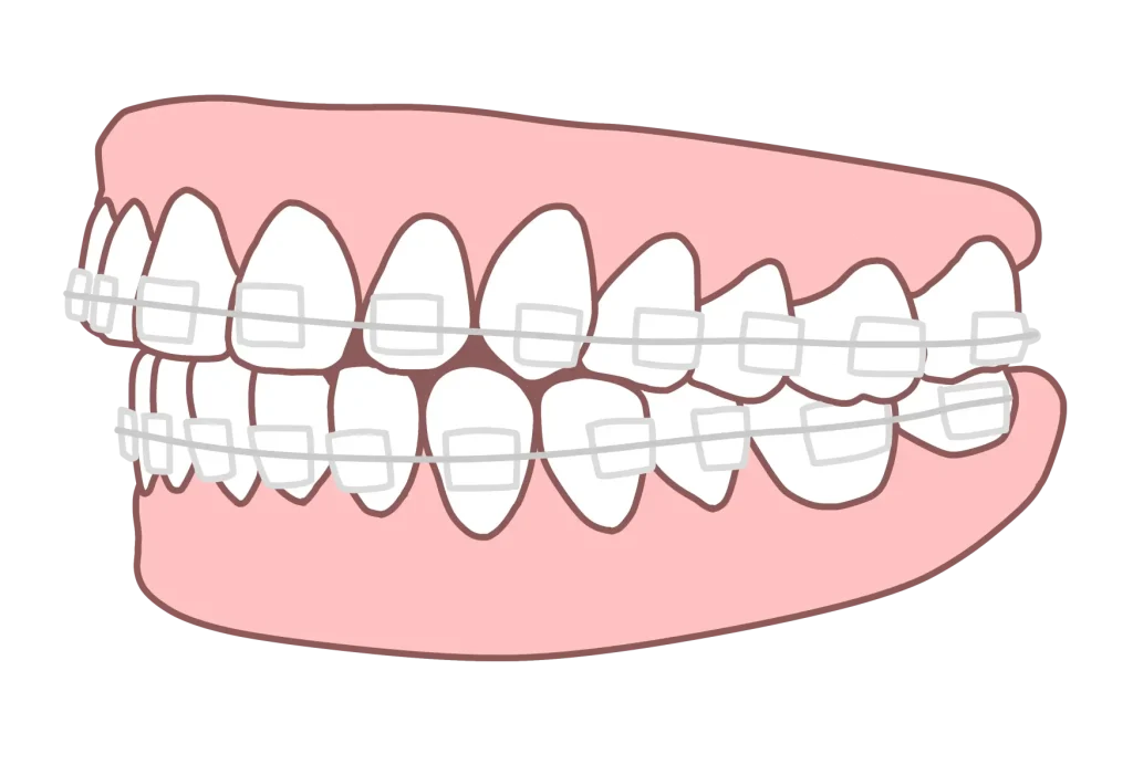 矯正後の後戻り