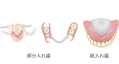 義歯（入れ歯）治療